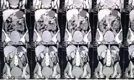 चिकित्सा क्षेत्र में नई ज्योति,बिना चीर-फाड़ के कैंसर का ऑपरेशन; जगी नई उम्मीद